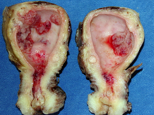Uterus_Endometrioid AdenoCA_cropped.jpg